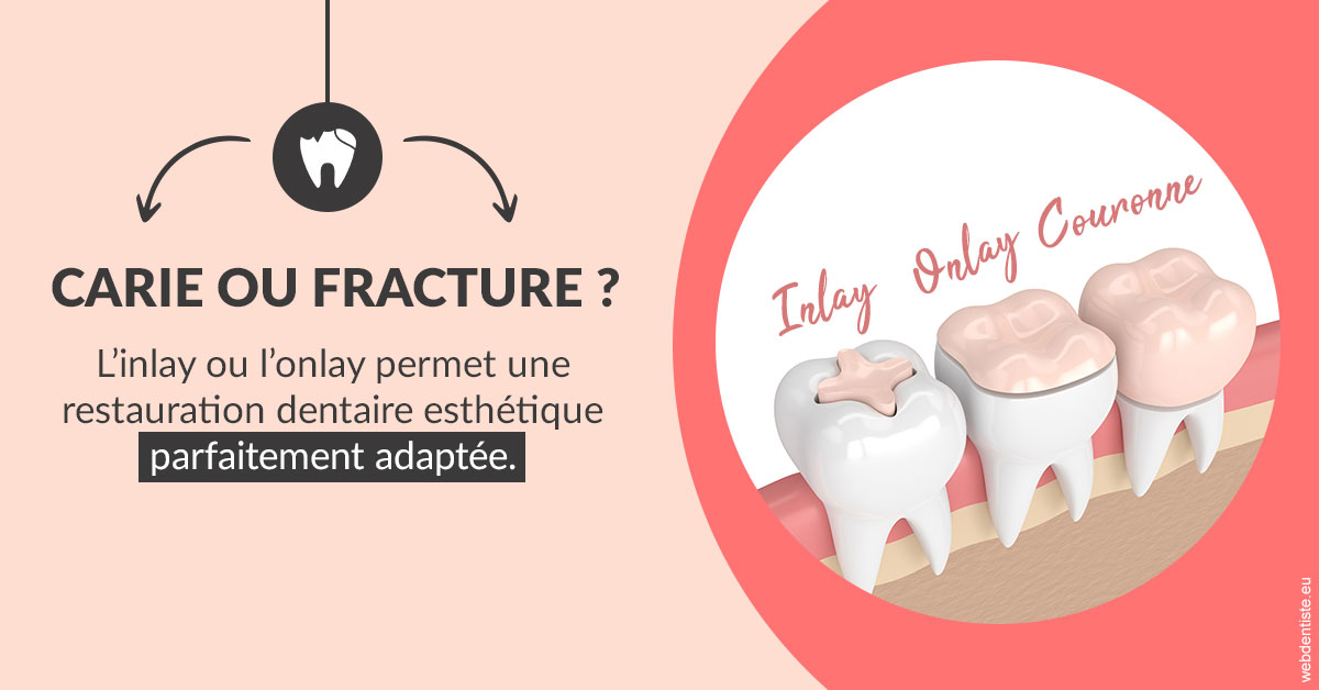 https://selarl-etienne-et-associes.chirurgiens-dentistes.fr/T2 2023 - Carie ou fracture 2