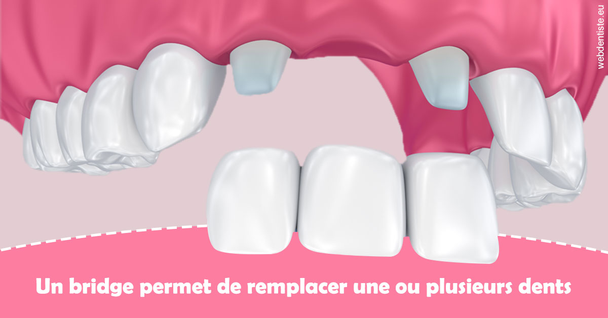 https://selarl-etienne-et-associes.chirurgiens-dentistes.fr/Bridge remplacer dents 2