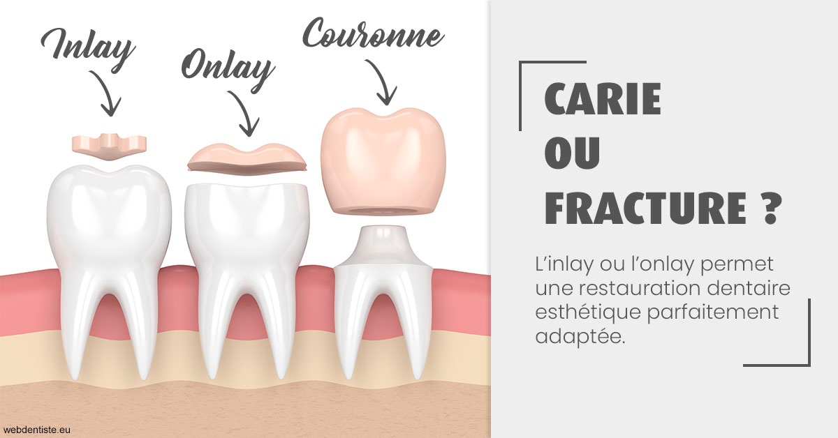 https://selarl-etienne-et-associes.chirurgiens-dentistes.fr/T2 2023 - Carie ou fracture 1