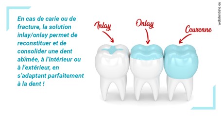 https://selarl-etienne-et-associes.chirurgiens-dentistes.fr/L'INLAY ou l'ONLAY