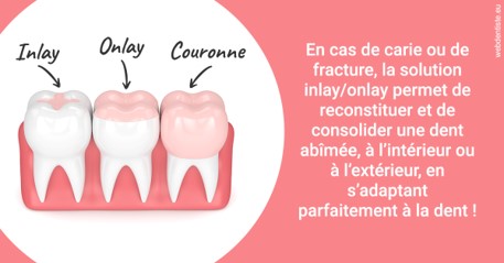 https://selarl-etienne-et-associes.chirurgiens-dentistes.fr/L'INLAY ou l'ONLAY 2