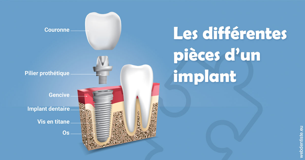 https://selarl-etienne-et-associes.chirurgiens-dentistes.fr/Les différentes pièces d’un implant 1